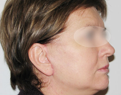 lifting twarzy - zdjęcie po operacji