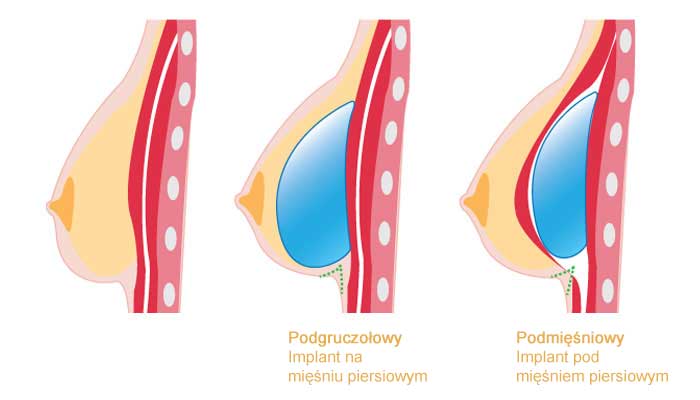 sposoby umieszczenia implantów piersi