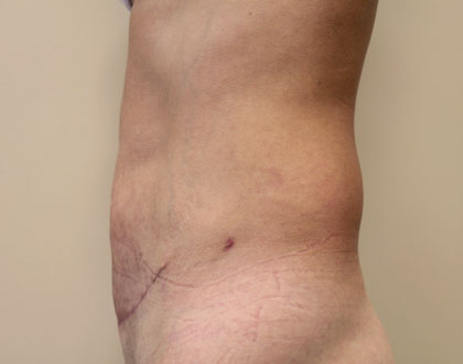 plastyka brzucha - zdjęcie po operacji