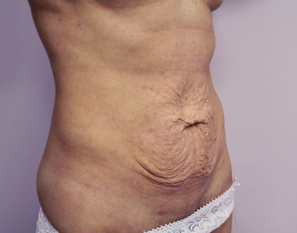 plastyka brzucha - zdjęcie przed operacją