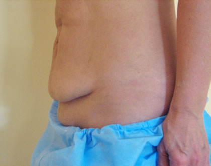 plastyka brzucha - zdjęcie przed operacją