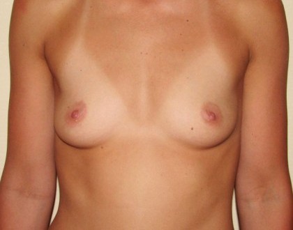 Powiększenie piersi - zdjęcie przed operacją