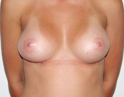 Powiększenie piersi - zdjęcie po operacji