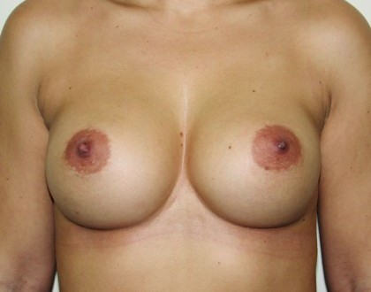 Powiększenie piersi - zdjęcie po operacji
