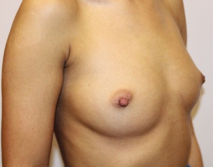 Powiększenie piersi - zdjęcie przed operacją
