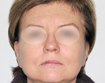 lifting twarzy - zdjęcie po operacji