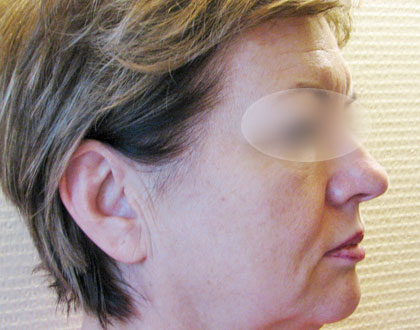 lifting twarzy - zdjęcie przed operacją