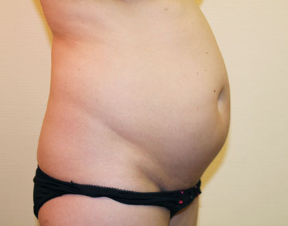 liposukcja - zdjęcie przed operacją