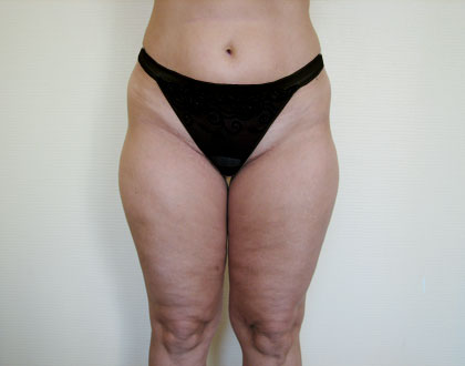 liposukcja - zdjęcie przed operacją