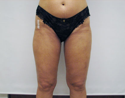 liposukcja - zdjęcie po operacji